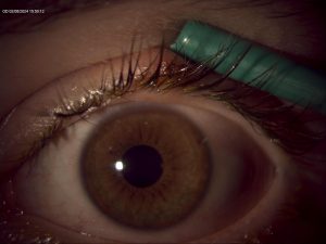 Keti Eye Clinic Ophthalmology Clinic Chalazion 2