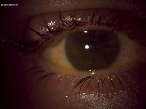 Keti Eye Clinic Ophthalmology Clinic Chalazion 3