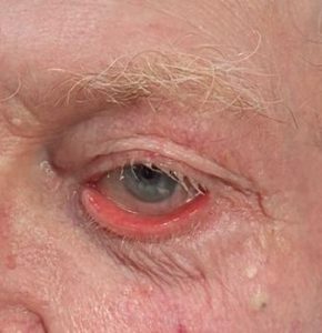 Keti Eye Clinic Ophthalmology Clinic Ectropion 1