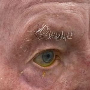 Keti Eye Clinic Ophthalmology Clinic Ectropion 3