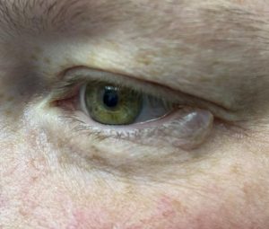 Keti Eye Clinic Ophthalmology Clinic Eecrine cyst