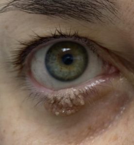 Keti Eye Clinic Ophthalmology Clinic Seborrheic Keratoses