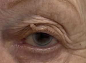 Keti Eye Clinic Ophthalmology Clinic Verruca Vulgaris