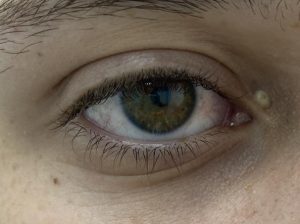Keti Eye Clinic Ophthalmology Clinic Xanthelasma